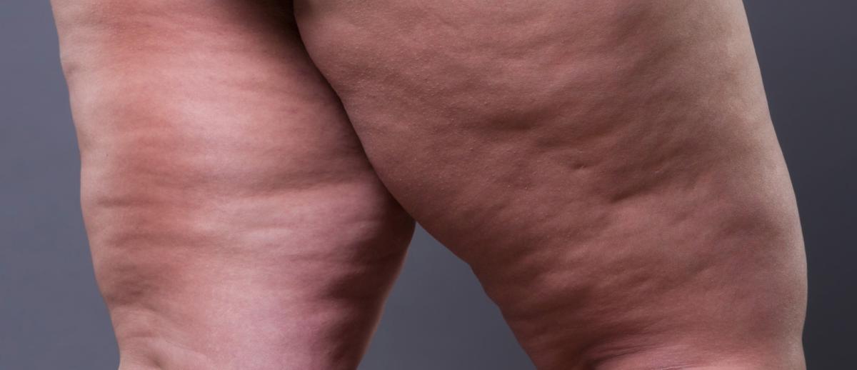 Vaser Liposuction / Thigh Lift